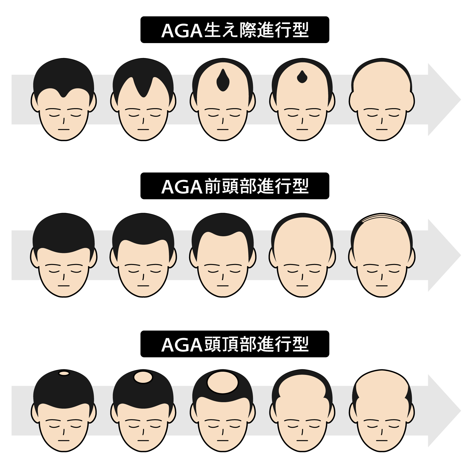AGA：男性ホルモン型脱毛症（男性型脱毛症）治療1
